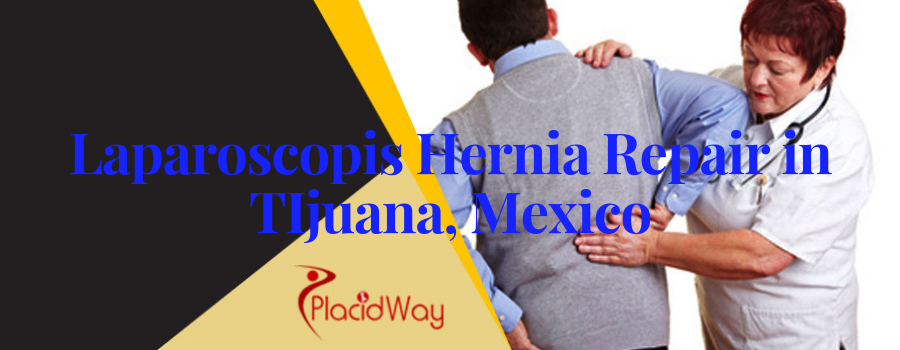 Laparoscopis Hernia Repair in Tijuana, Mexico